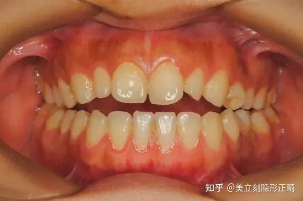 牙齿开合有哪些危害？ - 知乎