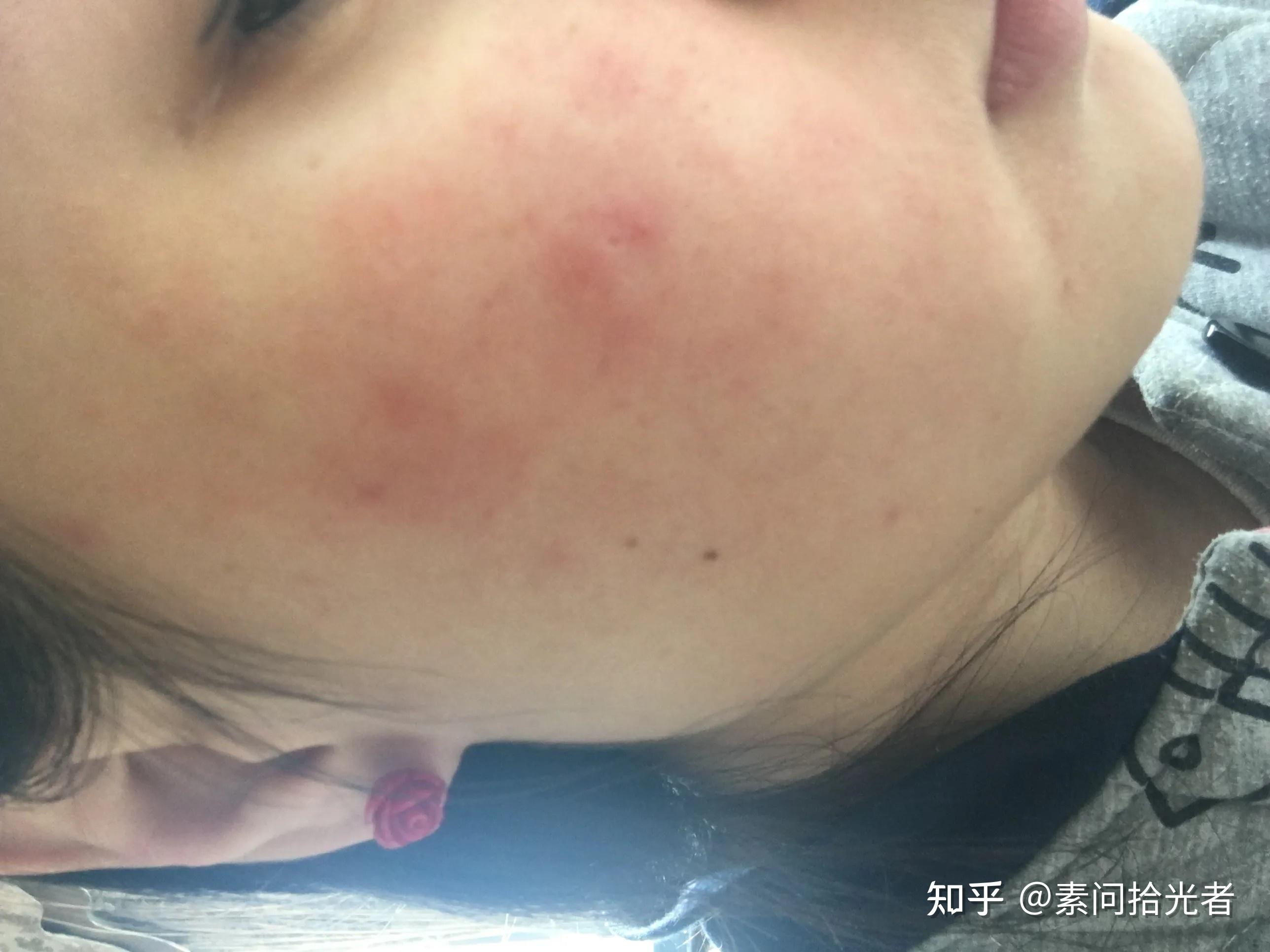 皮肤为什么会起红疹？ - 知乎