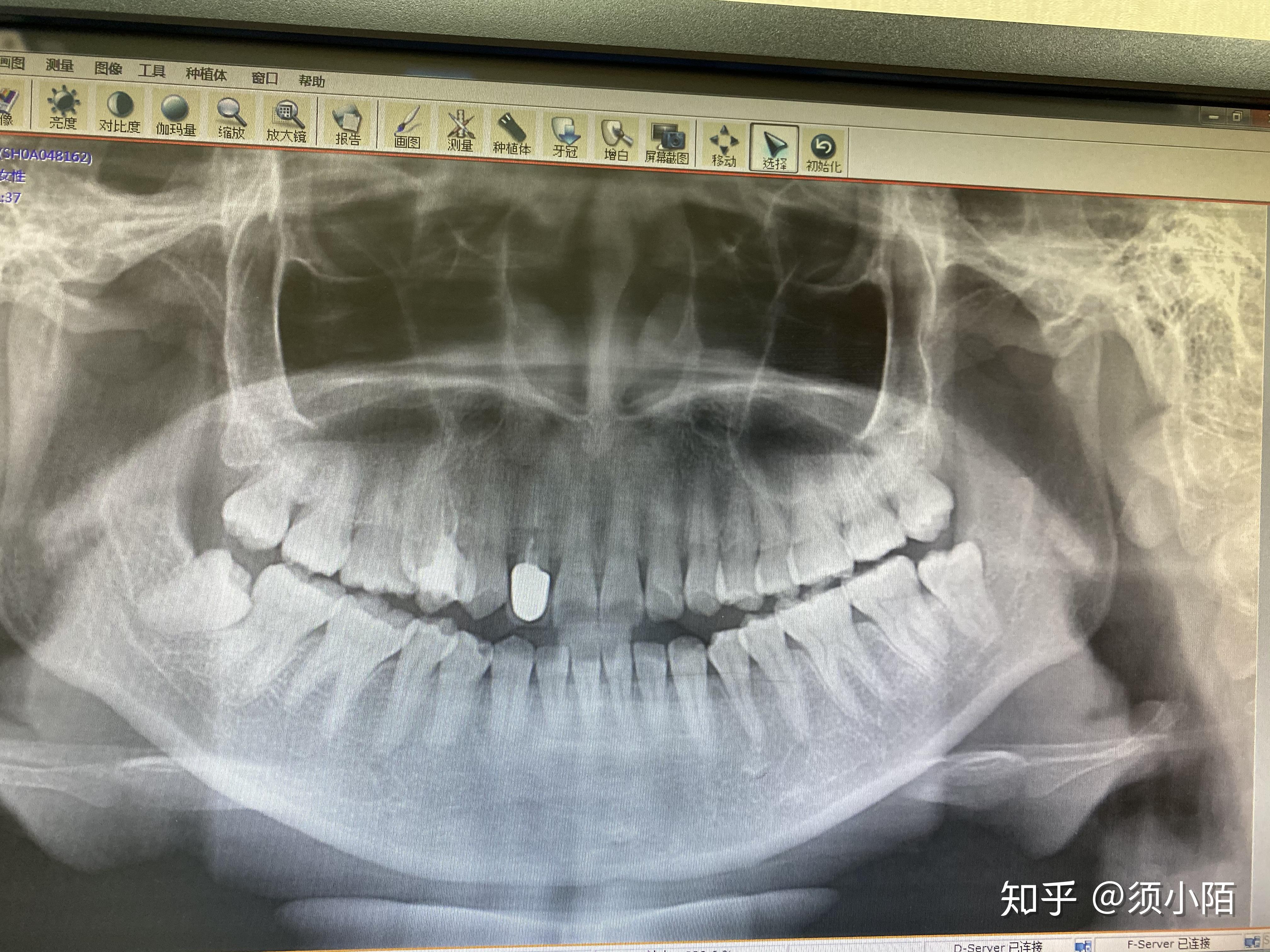 请问我哪几颗是蛀牙?