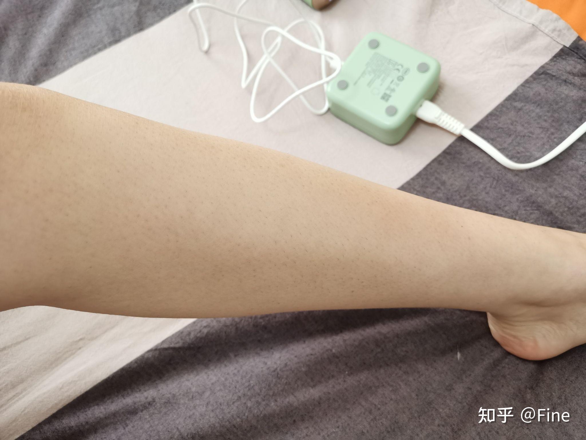 激光脱毛后有鸡皮肤(鸡皮肤可以激光脱毛吗)