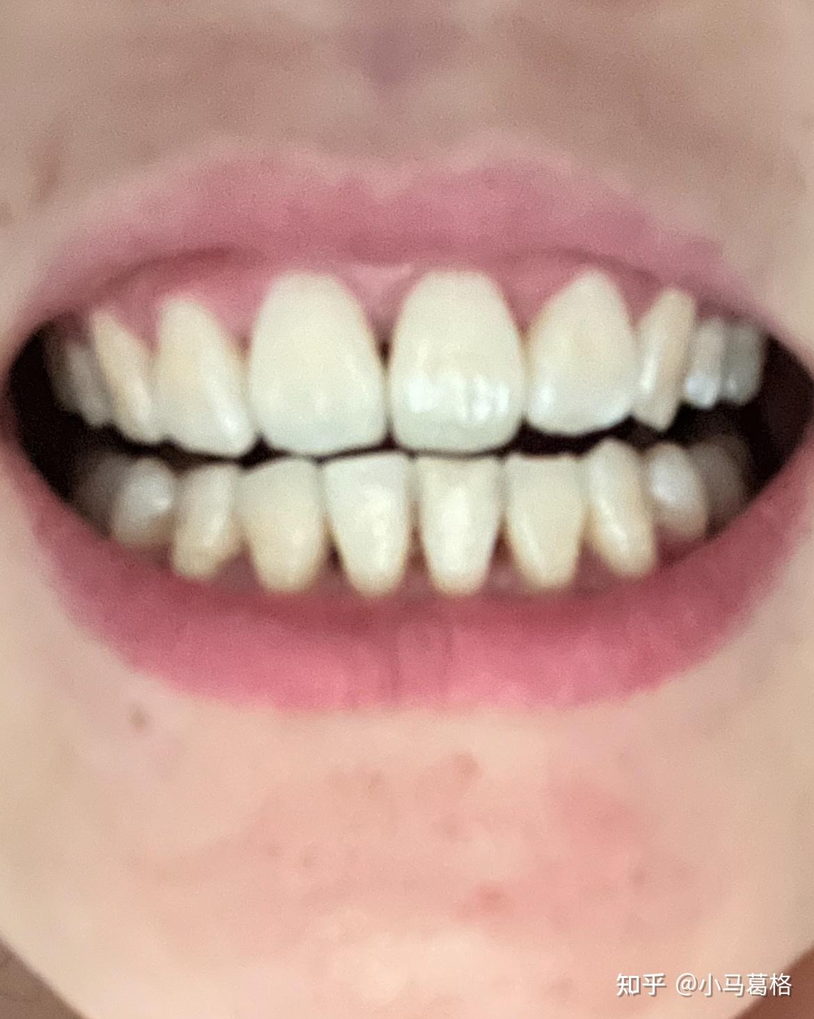 微笑美学修复：正畸结束，牙齿黑三角瓷贴面修复 - 知乎