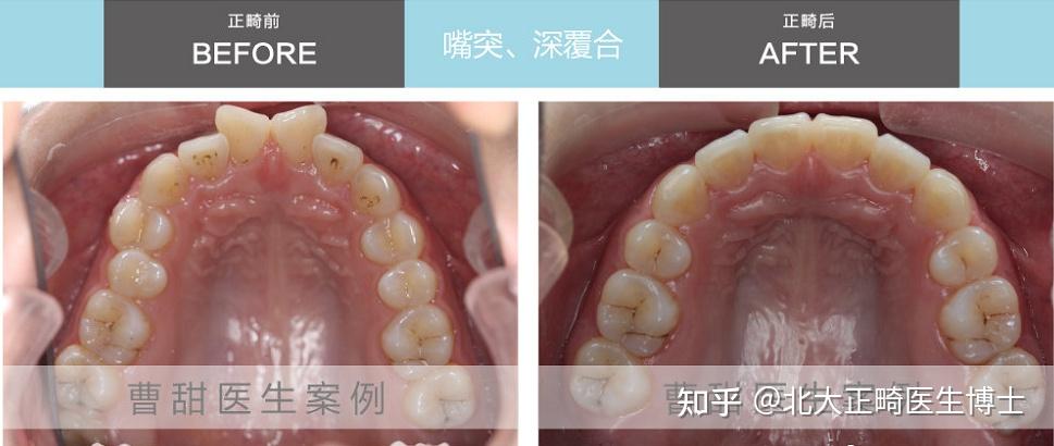 郑州隐适美认证医师曹甜:深覆合矫正时平导戴用的科普