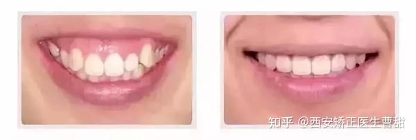 笑起来不好看？如何通过矫正获得适合自己的笑线 |西安牙齿矫正曹甜科普 - 知乎