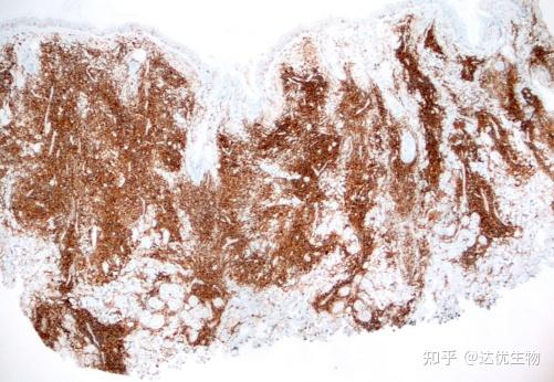 CD3、CD20…揭秘淋巴瘤免疫组化报告上的“CD家族” - 知乎