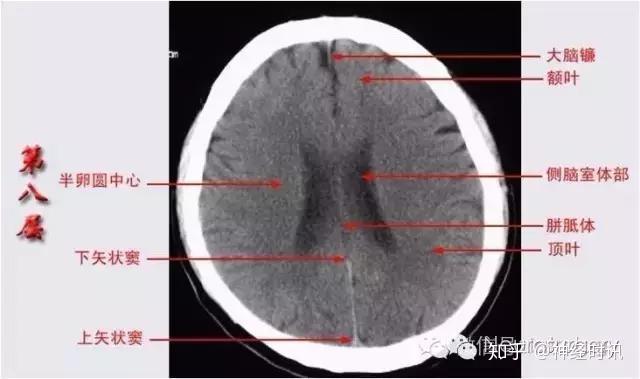 解剖&影像 —— 颅脑CT解剖口诀及彩色解剖图 - 知乎