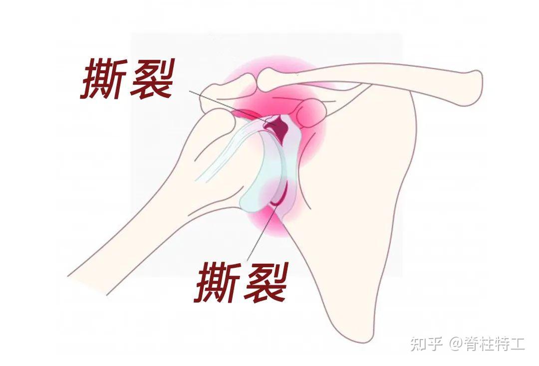 【肩痛预警地图】教你对图自查！（收藏版） - 知乎