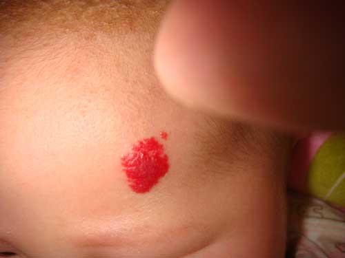 婴幼儿草莓状血管瘤的症状