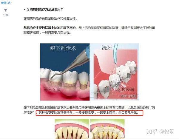 重度牙周炎的治疗过程和费用问题 亲历自述 知乎
