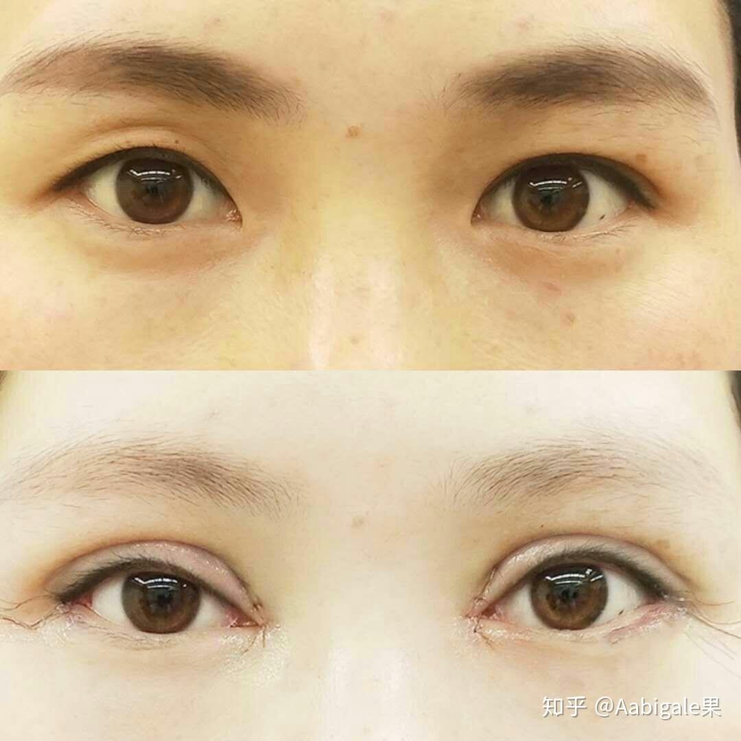 给大家分享一下,我今天刚做完眼综合的一个术前后对比…… - 知乎