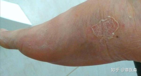 上海宁为啥老得 香港脚 知乎