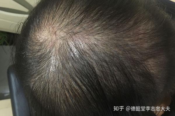 掉髮原因探秘：找到属于你的解药