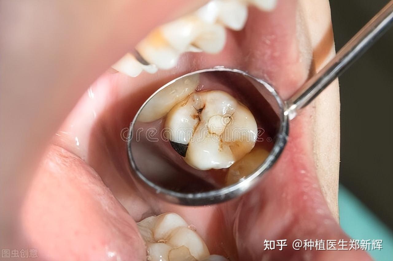 在深圳门牙补牙是如何补的？难度在哪？医生追求的是什么？ - 知乎