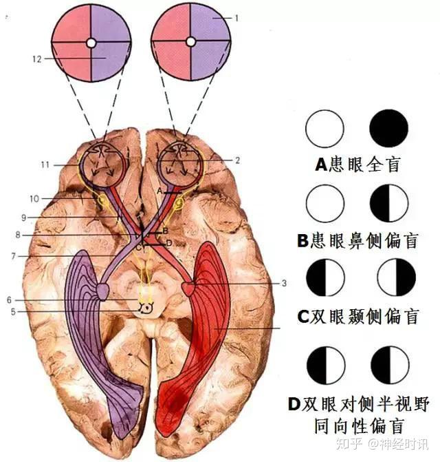 核上瘫和核下瘫区别图片