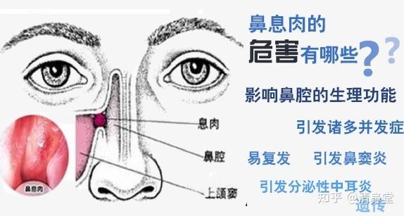 什么是鼻息肉？鼻息肉的危害有哪些？ - 知乎