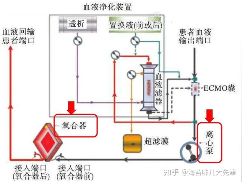 ecmo系统示意图图片