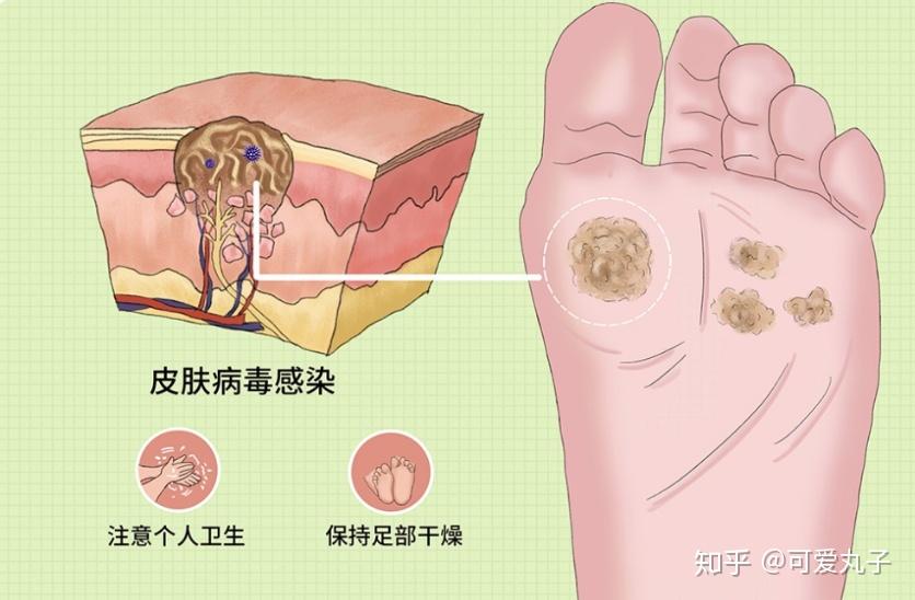 蹠疣:蹠疣多由人類乳頭瘤病毒感染引起,發生於一側或兩側足底,尤其易