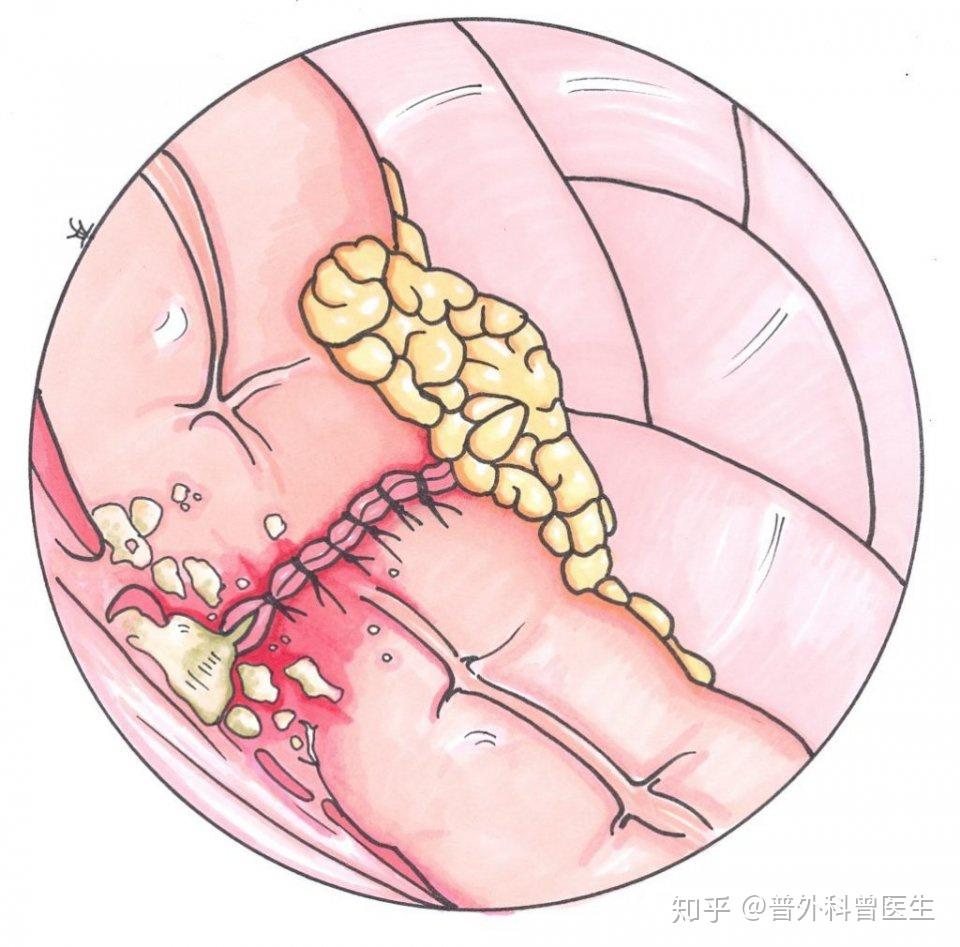 肠癌引起肠梗阻怎么办一定要做造口吗其实还有其他办法