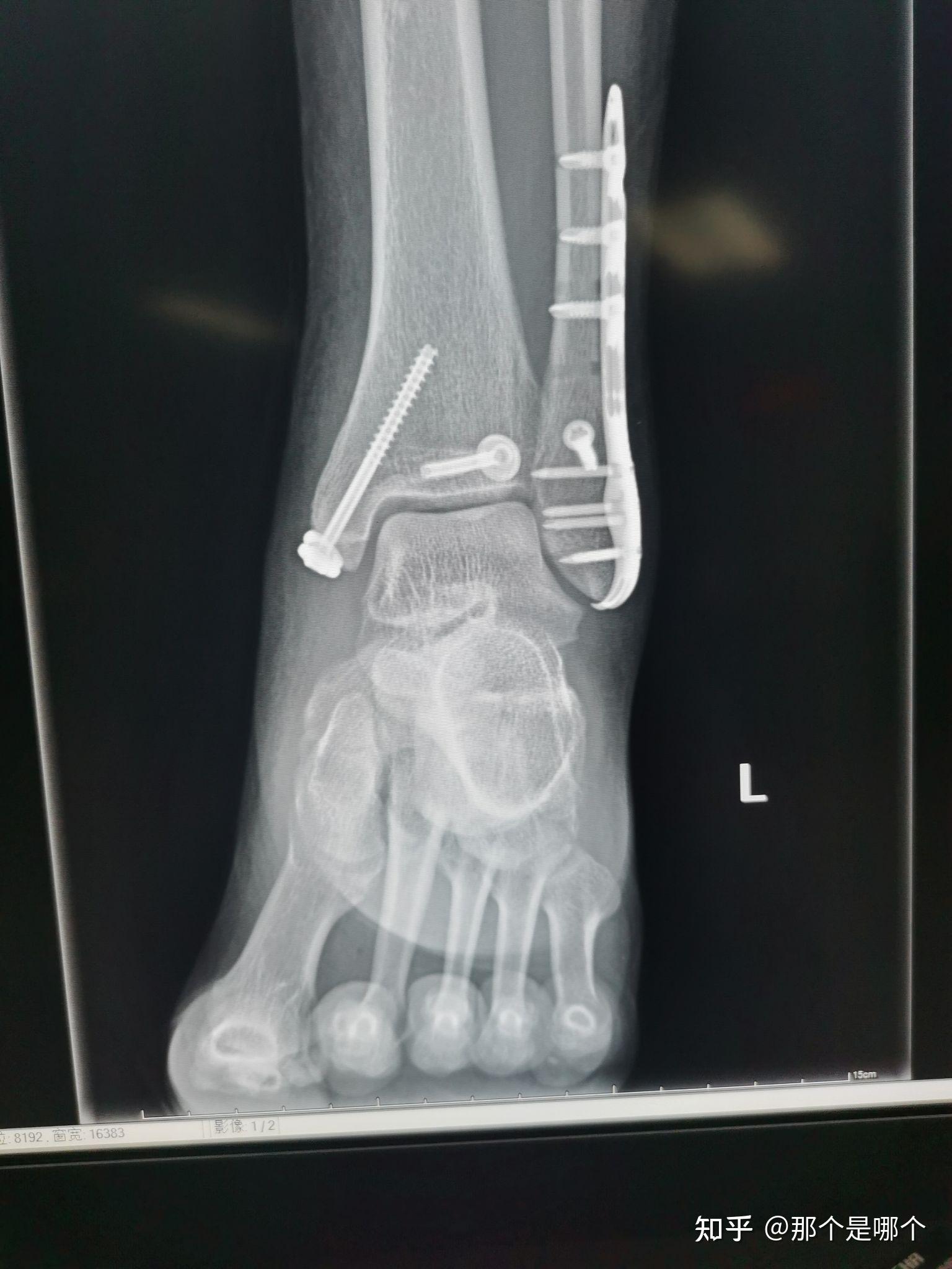 左踝关节骨折之术后一个月复查