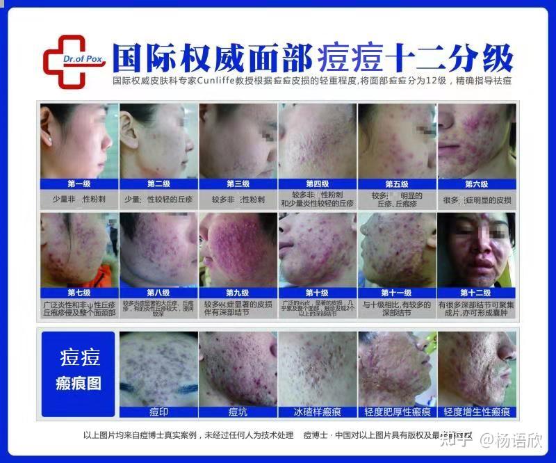 痘痘下不去越来越严重快烂脸了怎么办