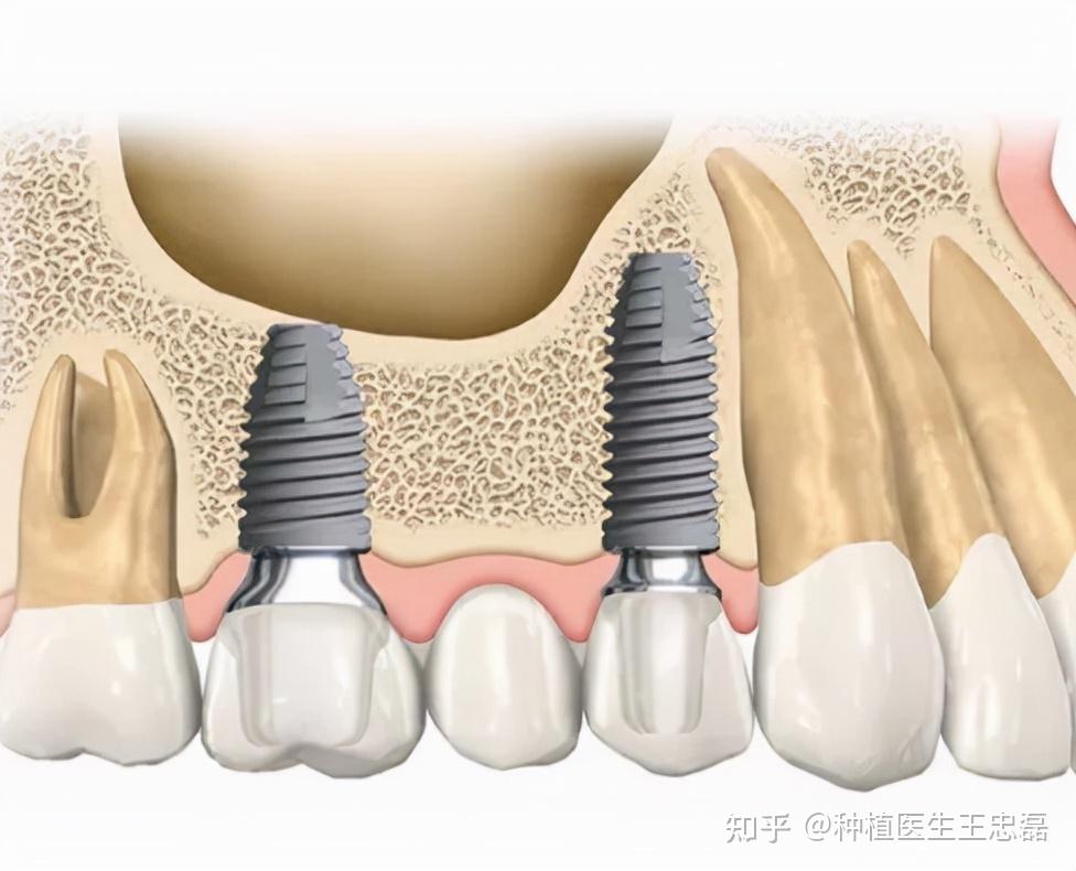 有严重牙槽骨萎缩不愿意接受植骨手术直接种牙有什么后果
