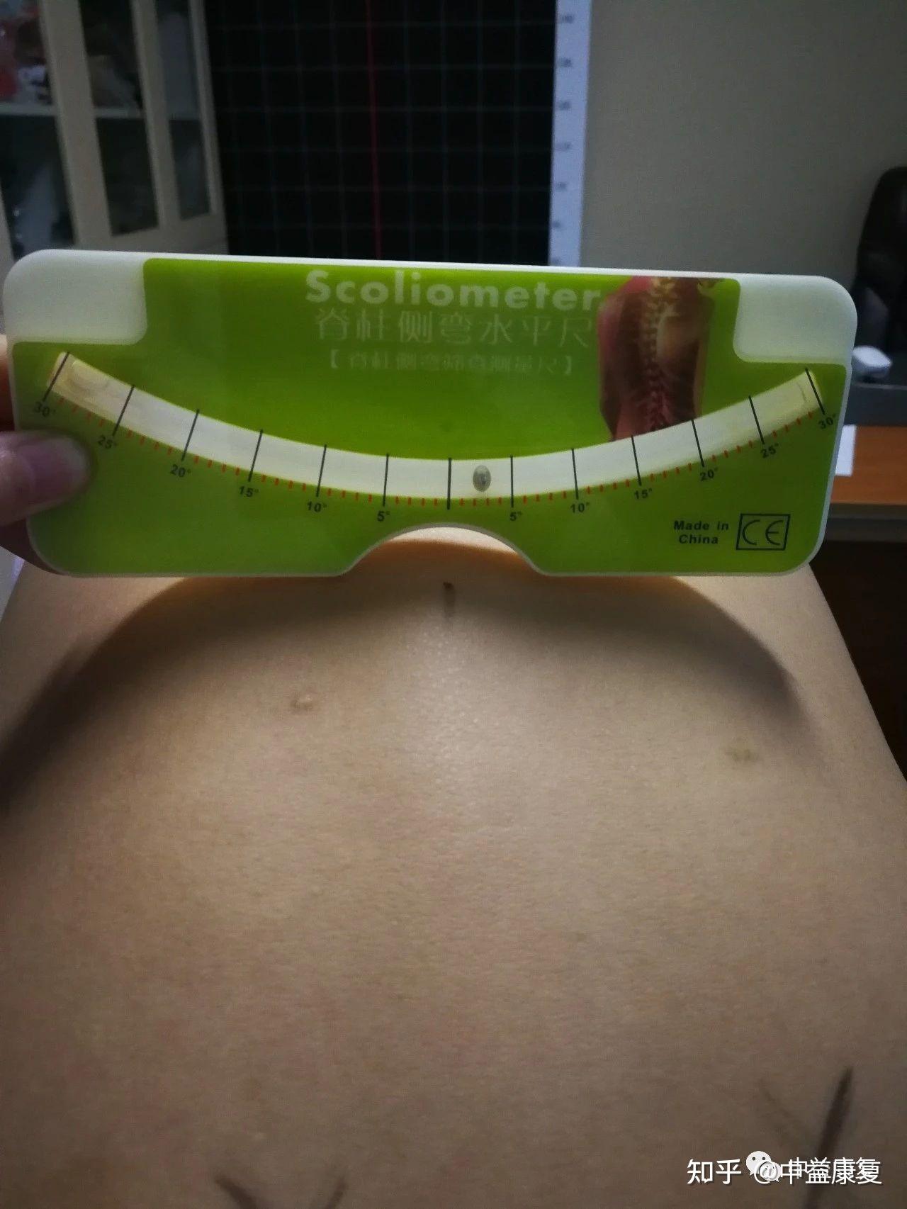 3,剃刀背评估侧面观背面观正面观2,红外线对线评估髂前上棘胸骨切迹