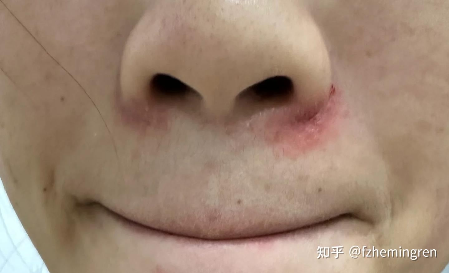 10年脂溢性皮炎患者亲述:我用血泪史告诉你,维生素B6到底能不能治脂溢性皮炎 - 知乎
