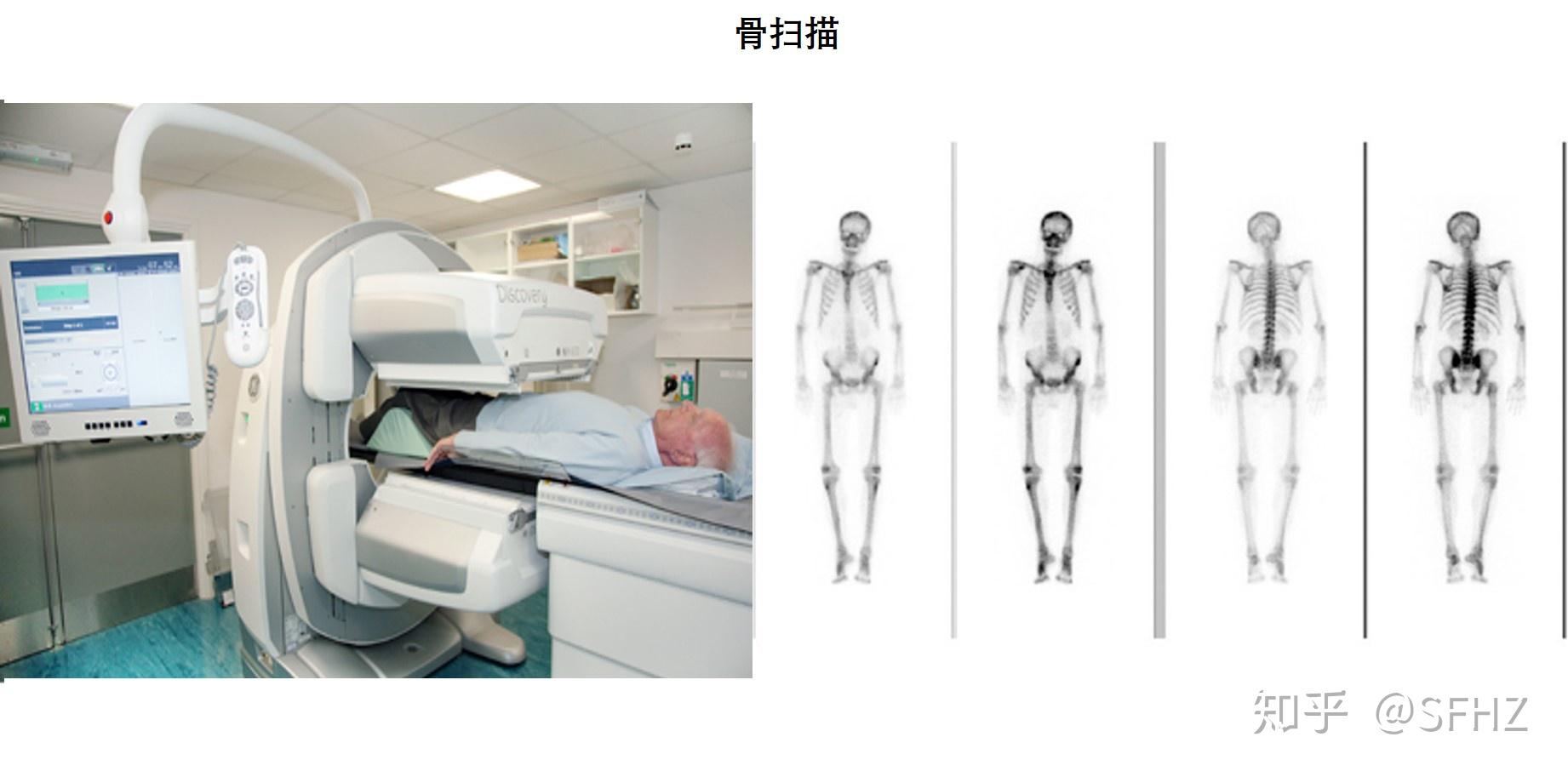 一文讀懂放化療為主的小細胞肺癌的診斷病理分期和治療上