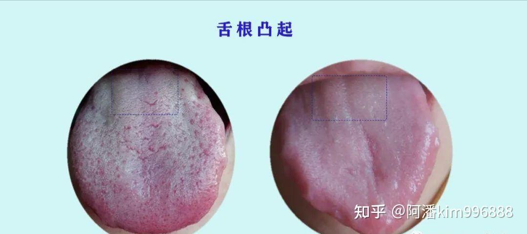 凸起胃口差,吸收不好導致中下焦運化不足飲食較多,較雜脾胃區凸起