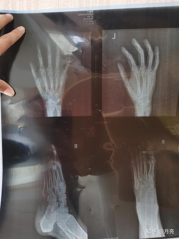 小拇指轻微骨折照片 小拇指骨折图片 怎么判断小拇指骨折了