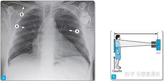 ①后前位(posteroanterior view,pa view)投照体位:x线从患者背后穿透