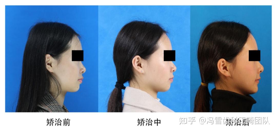 案例分享 | 牙齿矫正带来的改变到底有多大? - 知乎