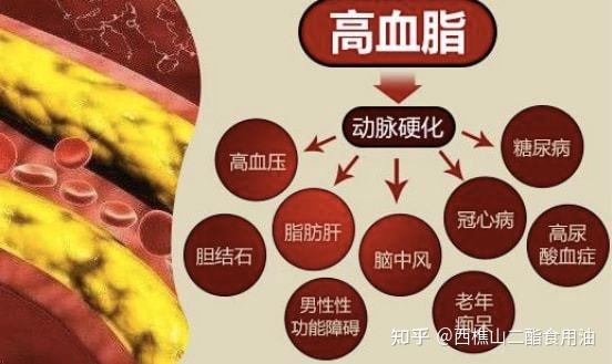 高血脂看着一篇就够了! - 知乎