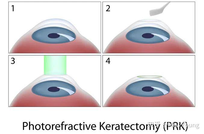 近视激光手术原理图片