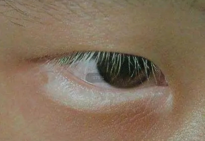 黑色素的缺失导致耳朵眼里出现白斑,比如近视,花眼,短暂性失明,视力