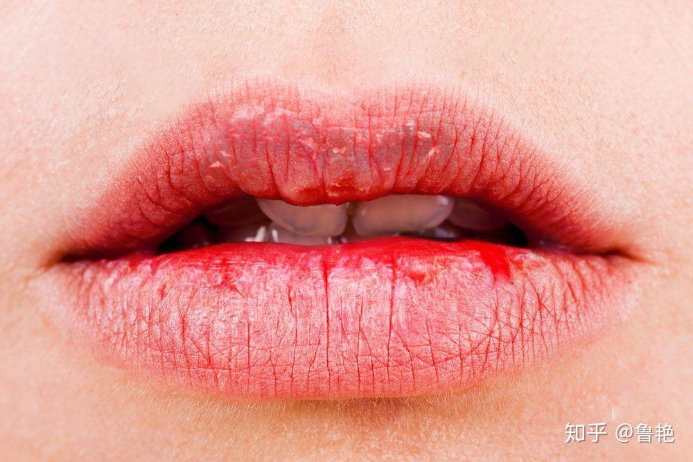 越撕越多反复撕后嘴唇火辣辣地疼除了会引发唇炎,还会长出血管瘤…▼
