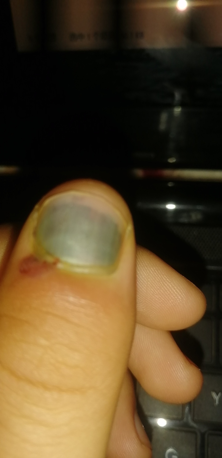 指甲盖被车门挤黑淤血如何处理记录过程