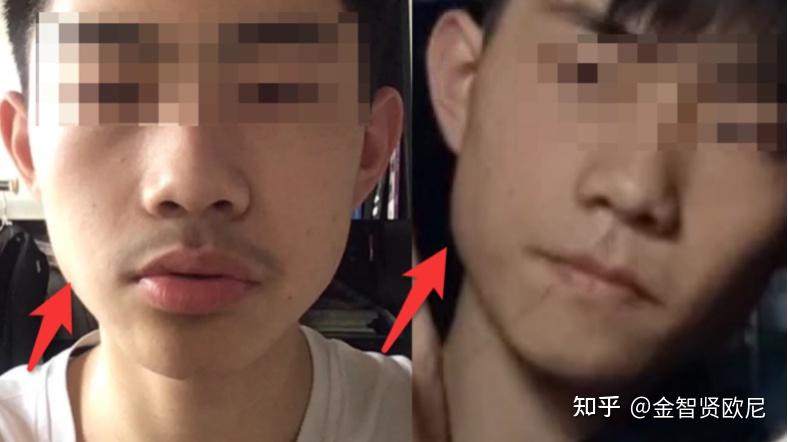 男生发腮如何用医美手段高效解决? - 知乎