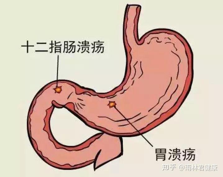 雨林君健康说口腔溃疡的这些危害你可能不知道