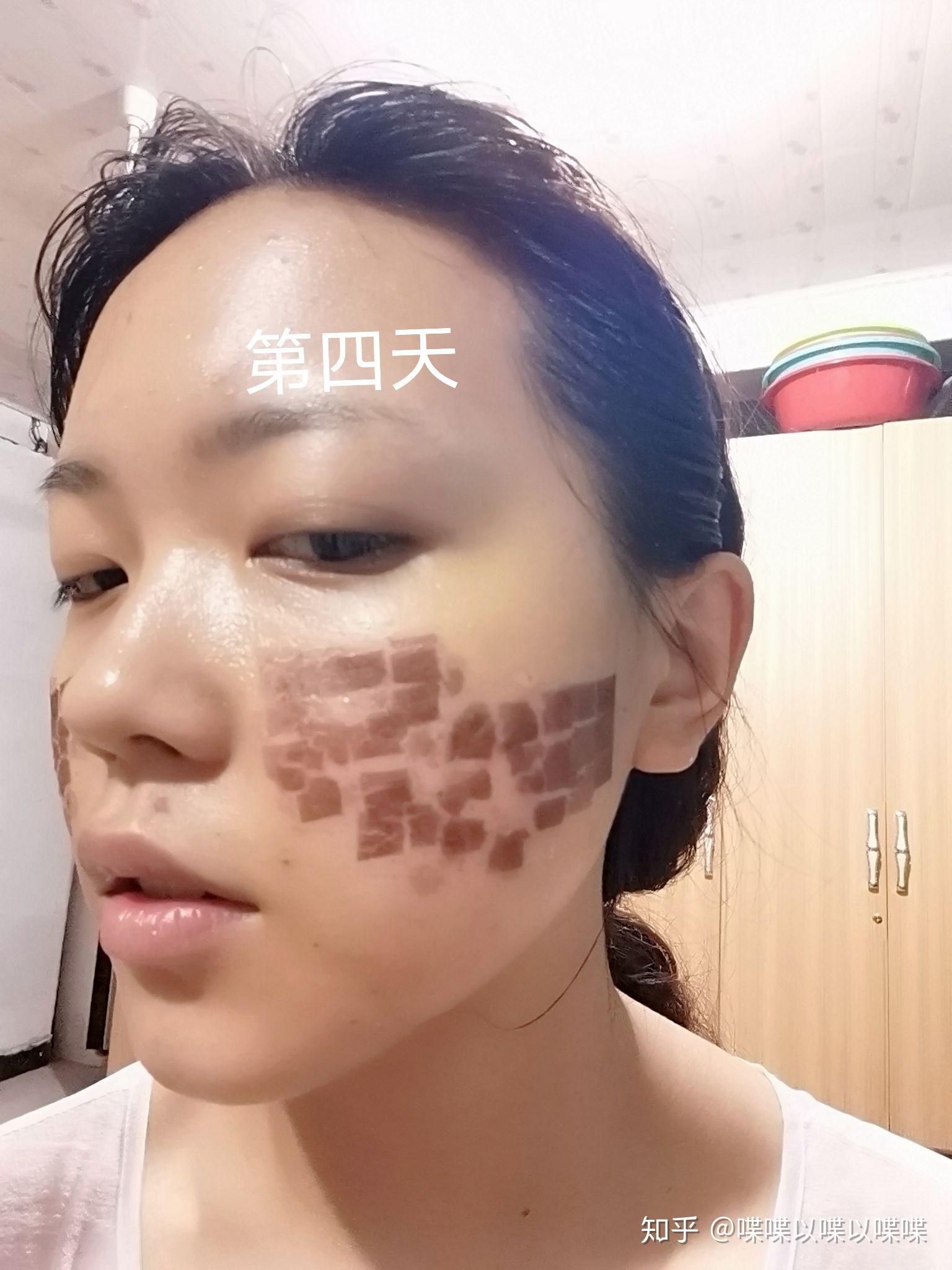 激光祛痘坑后结痂掉痂和皮肤状态情况