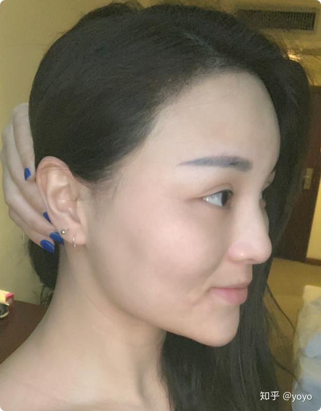 明星植发全记录