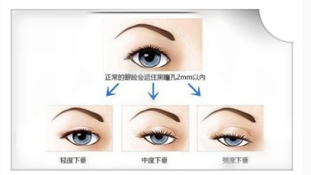 我们人的上脸提肌和米勒氏肌的力量薄弱,需使用眉毛和额头的力量睁开