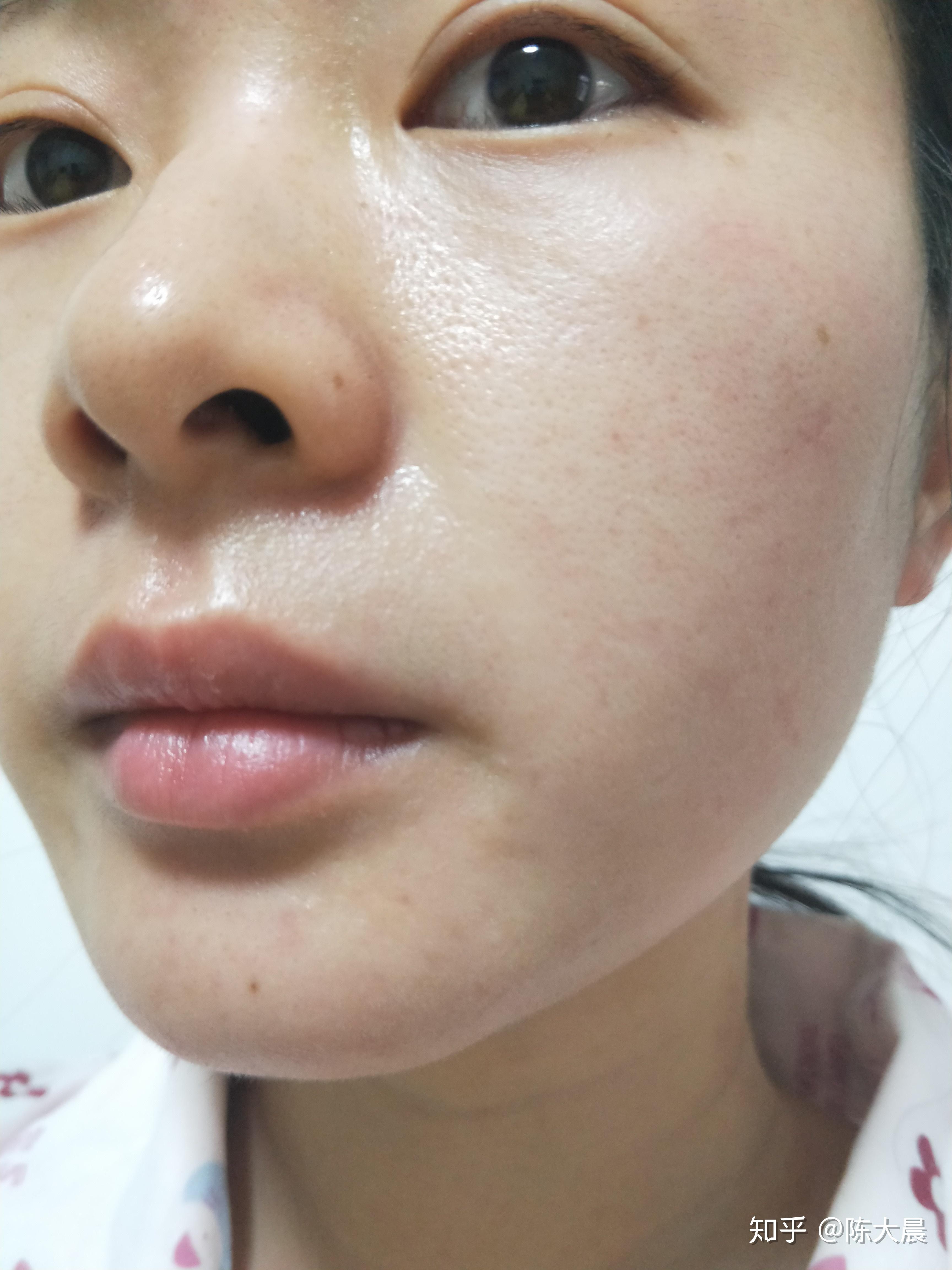 激素脸别再入坑了