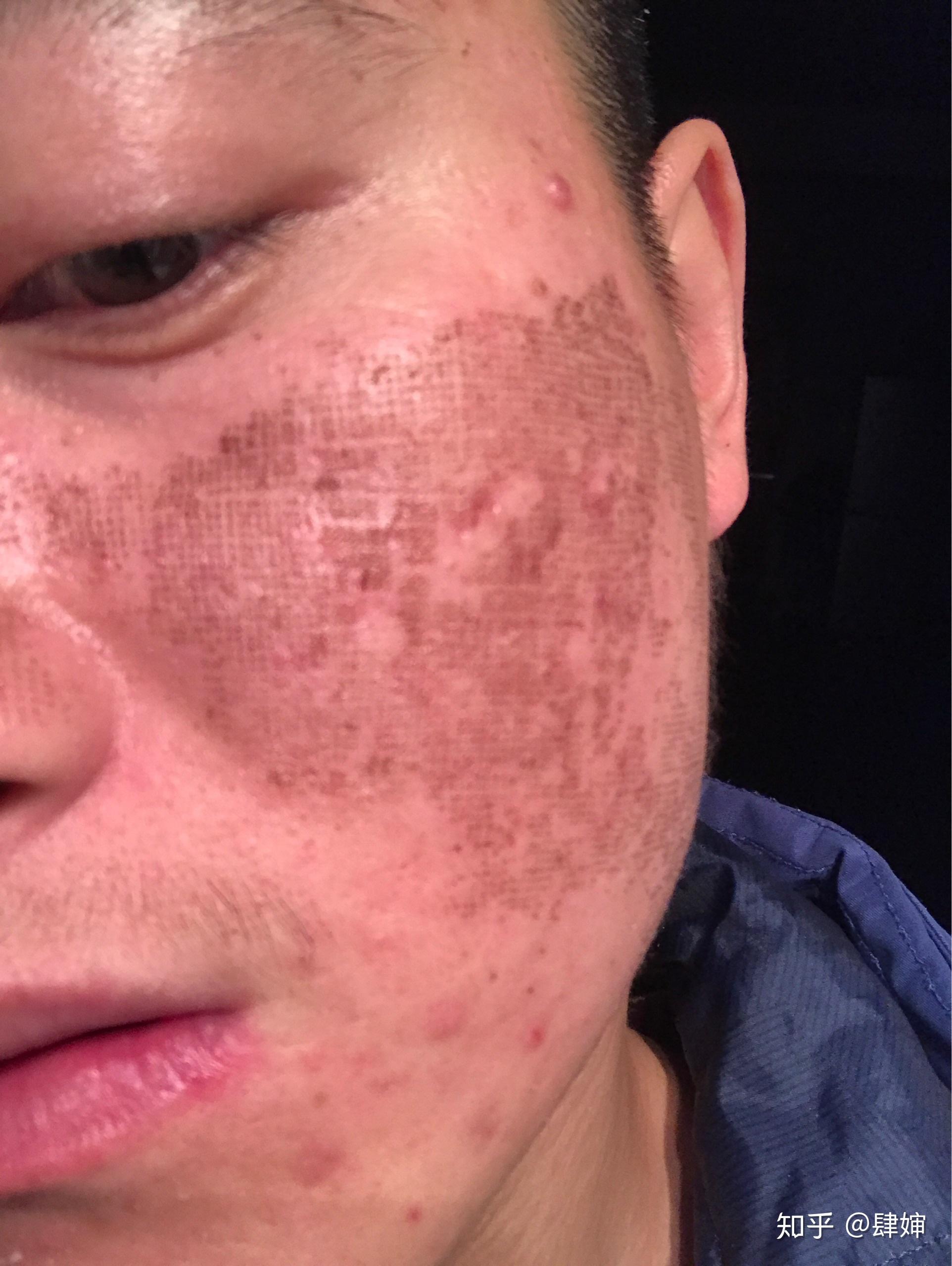 记录下点阵激光治痘坑