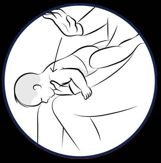 异物阻塞气道窒息背击法胸戳法