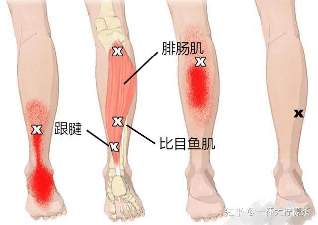 小腿抽筋又被称为小腿处的肌肉痉挛,多发生于腿肚,也就是腓肠肌的位置