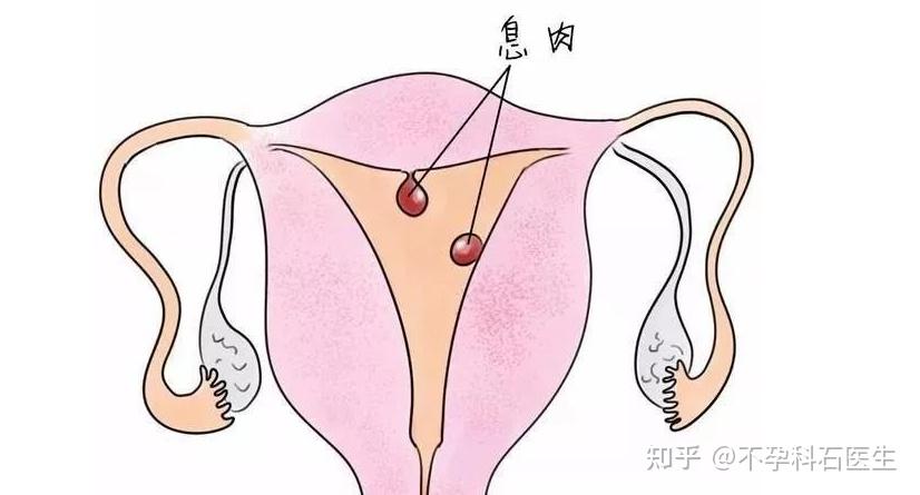 子宮內膜息肉是個什麼病