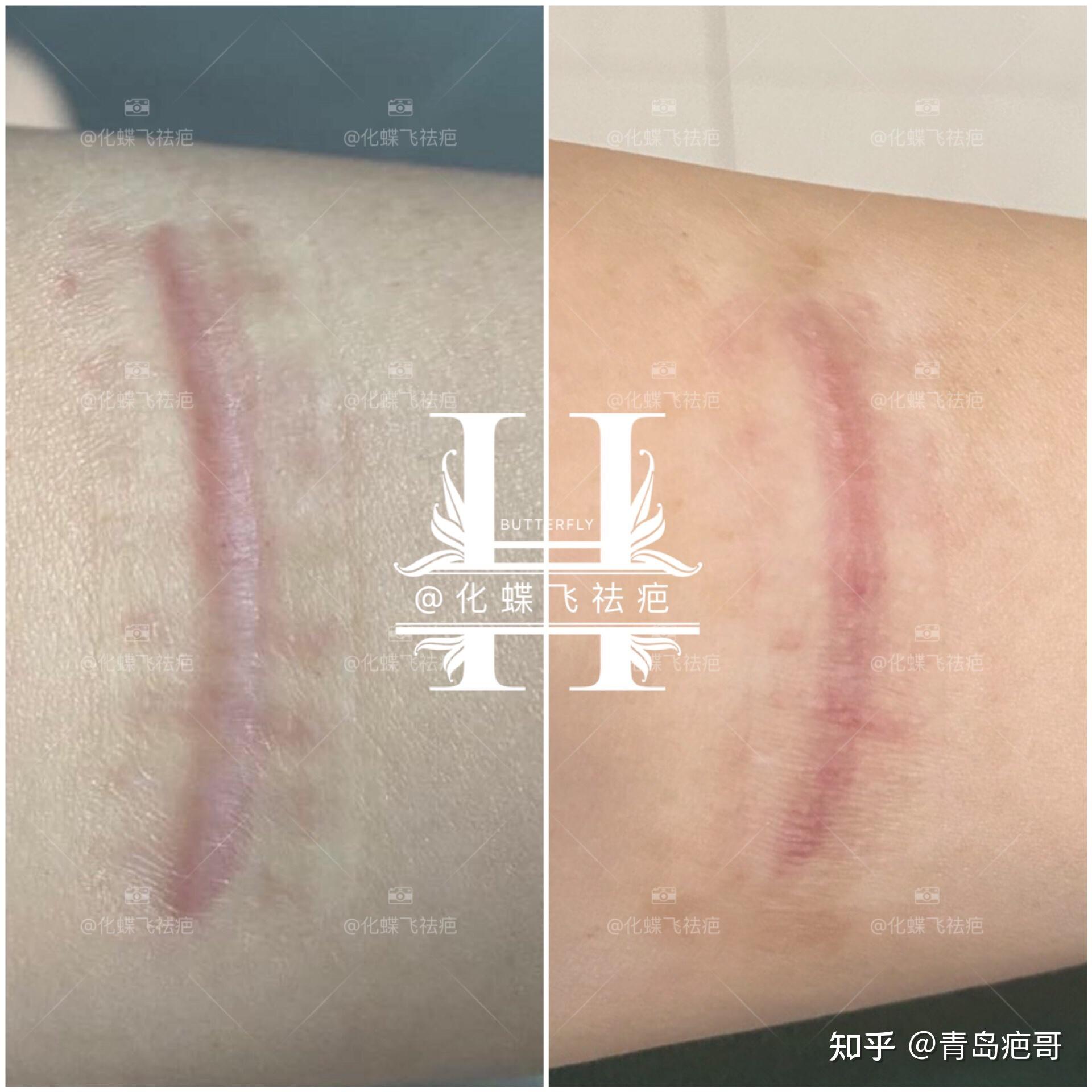 美女胳膊上的增生性疤痕
