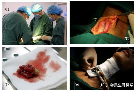 医院甲状腺科知名专家叶真教授主刀,为喉癌患者成功开展3/4喉切除手术
