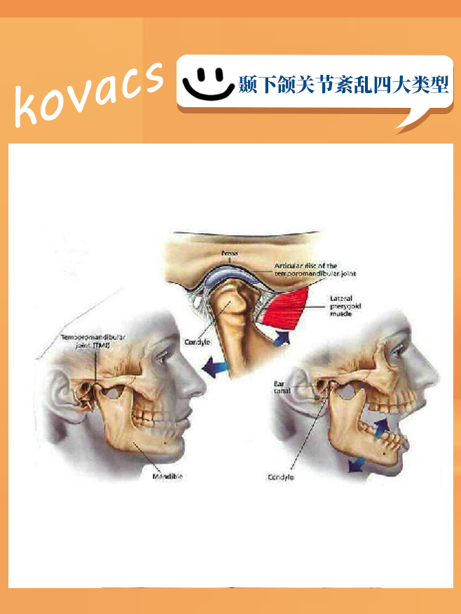 科普答疑不可复关节盘移位到底是什么