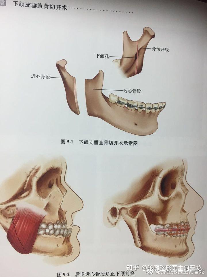 下颌升支 解剖图图片